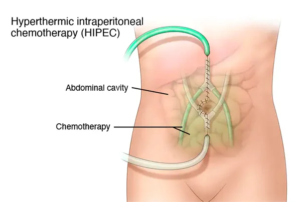HIPEC and Cytoreductive Surgery